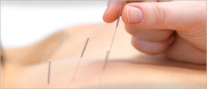 Acupuncture à repentigny