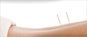 Acupuncture à repentigny