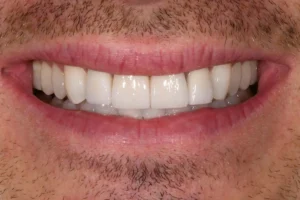 Akoya dentisterie esthétique